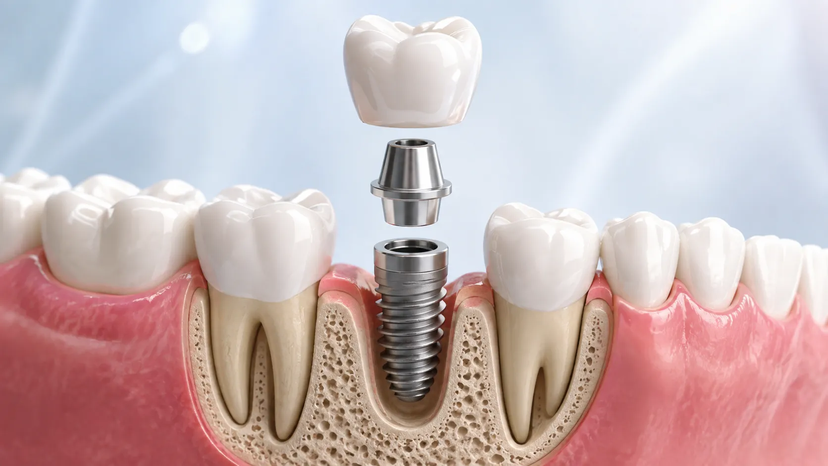 Implant dentaire : remplacer durablement une dent manquante